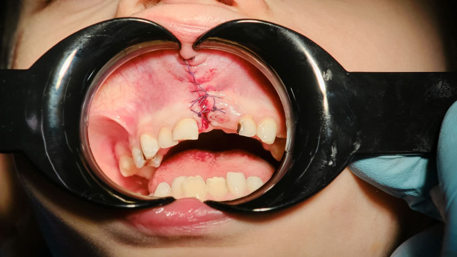 Chirurgia orale presso Aura Clinic a Valona